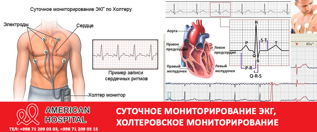 Холтеровское мониторирование