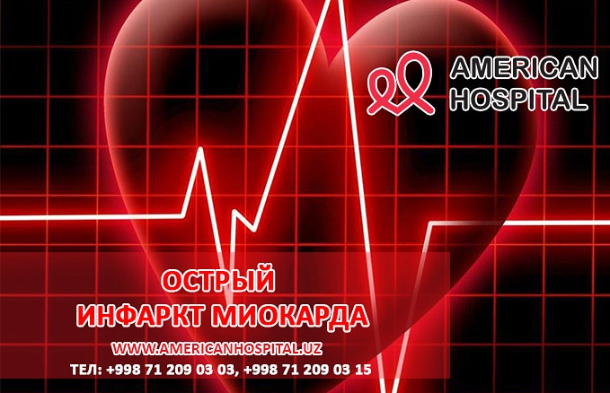Острый инфаркт миокарда