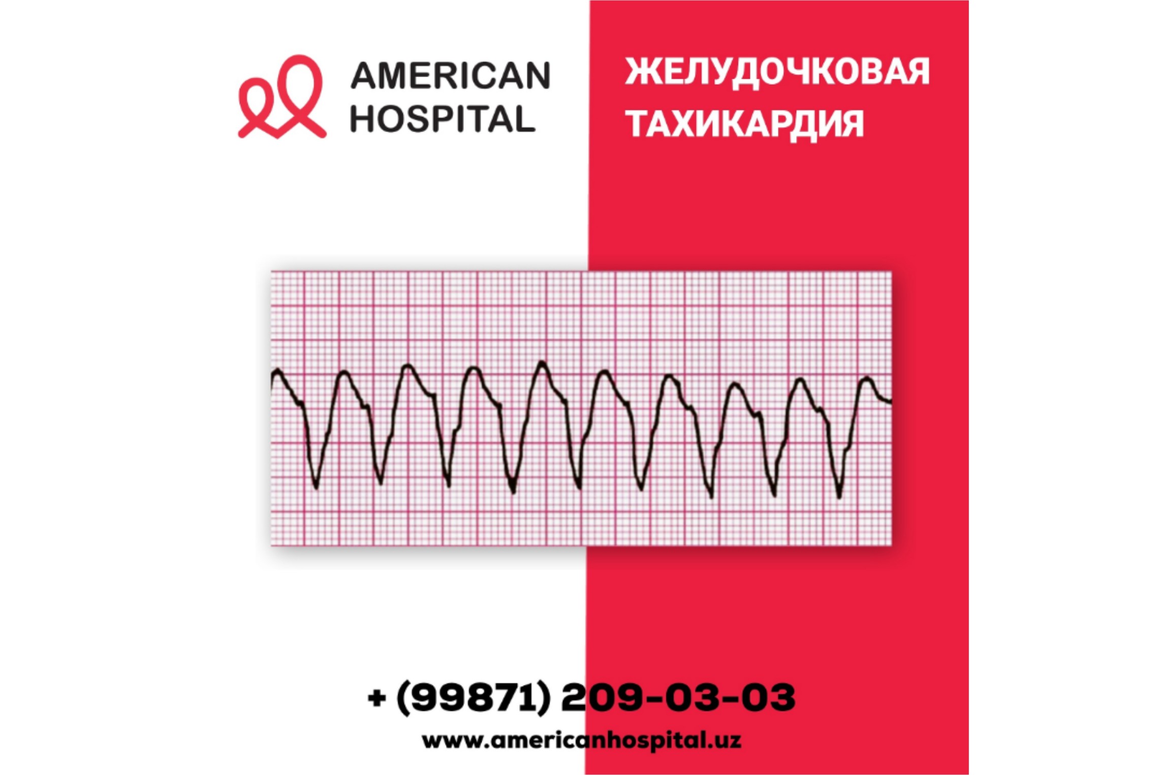 Желудочковая тахикардия